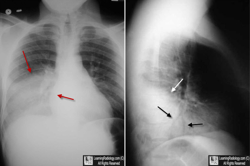 Right Lower Lobe Pneumonia